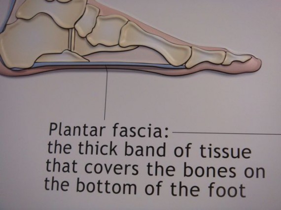 Plantar Fasciitis 