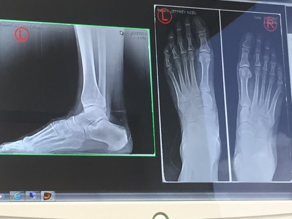 Foot X-rays 