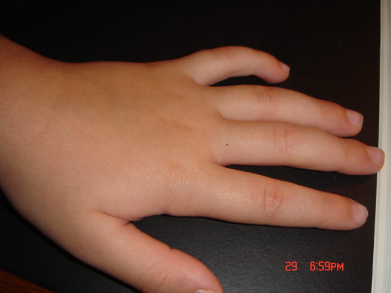 child's hand, swollen