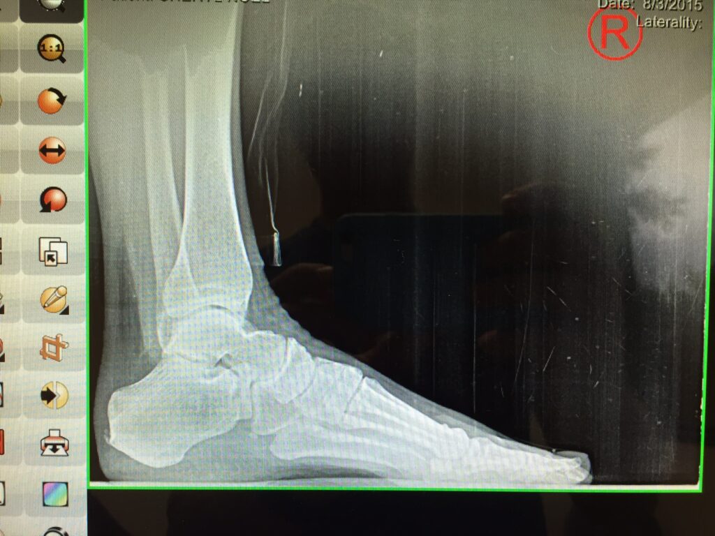 foot x-ray