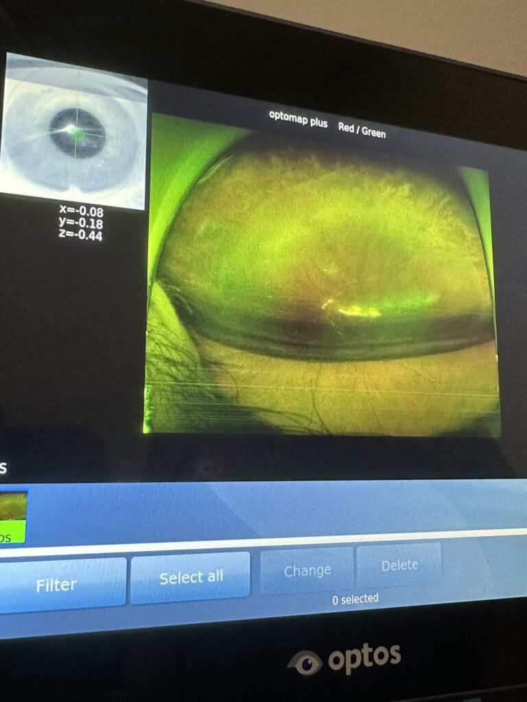 Photograph of a retina